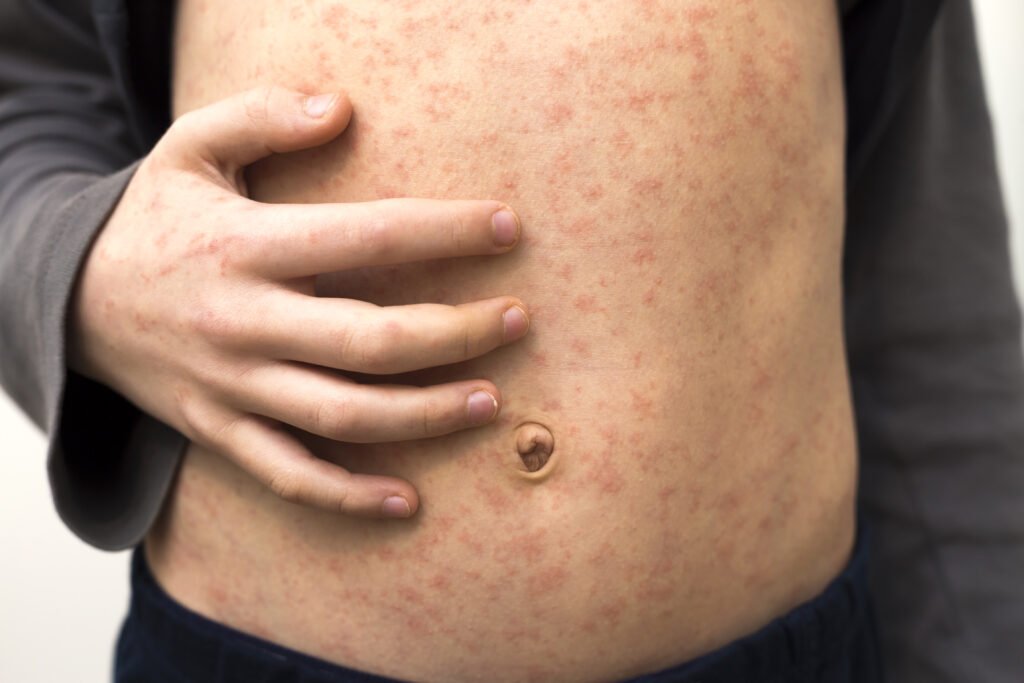 Chlamydia: Symptoms, Treatment & Prevention in Malaysia 47 sick child body stomach with red rush spots, Chlamydia symptoms