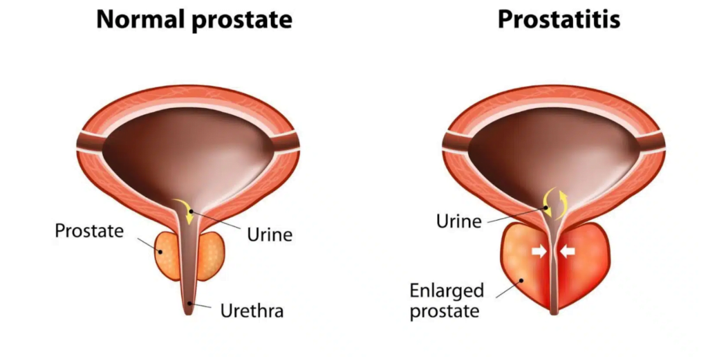 penile discharge