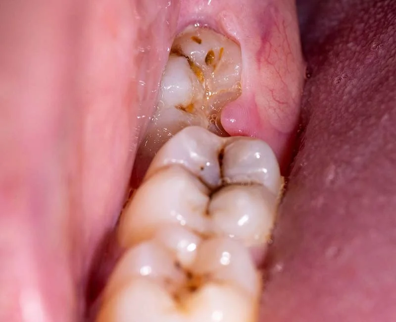 Impacted Wisdom Tooth: Everything You Need to Know in Malaysia 2 impacted wisdom teeth