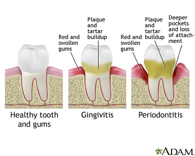 Risks of Untreated Gingivitis