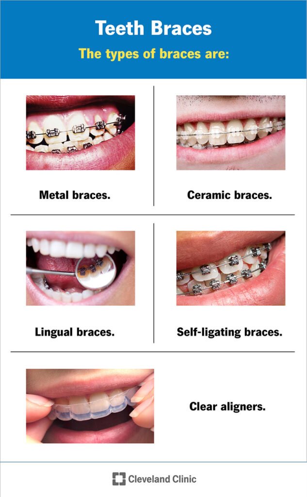 Braces: Everything You Need To Know in Malaysia 30 braces malaysia
