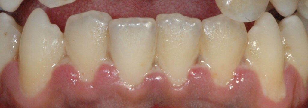 Acute Necrotizing Gingivitis 1