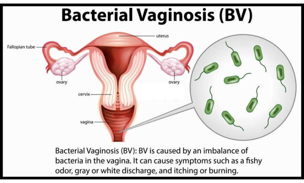 Bacterial Vaginosis