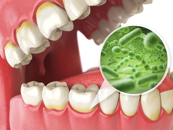 Causes of Gum Disease