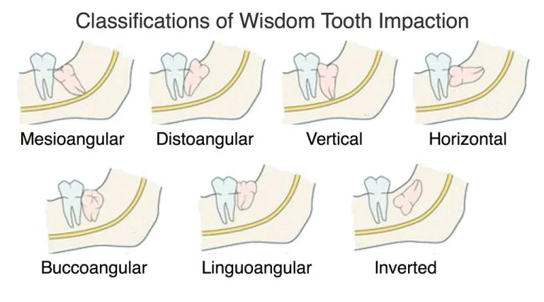 Impacted Wisdom Tooth: Everything You Need to Know in Malaysia 1 Impacted of Wisdom Tooth