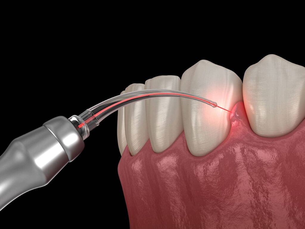 Laser Assisted Therapy for Gum Disease