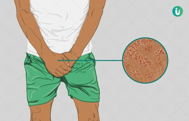 Penile Yeast Infection: Everything You Need to Know in Malaysia 2 Penile Yeast Infection Symptoms