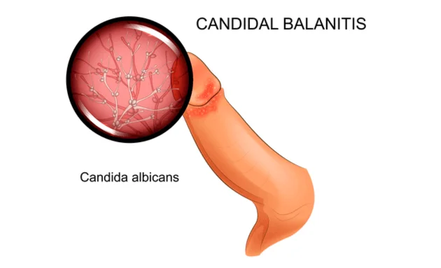Penile Yeast Infection Everything You Need to Know in Malaysia