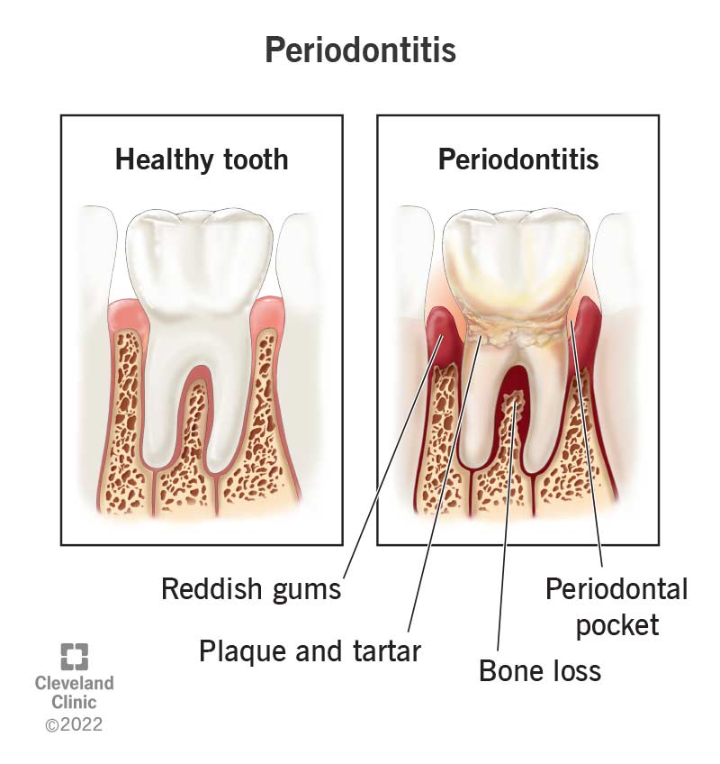 Periodontitis