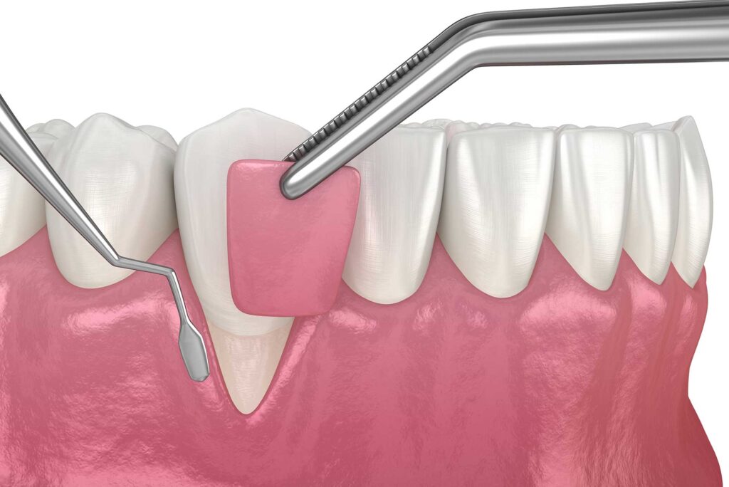 Surgical Treatment Methods for gum disease