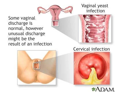 Symptoms of vaginal itching