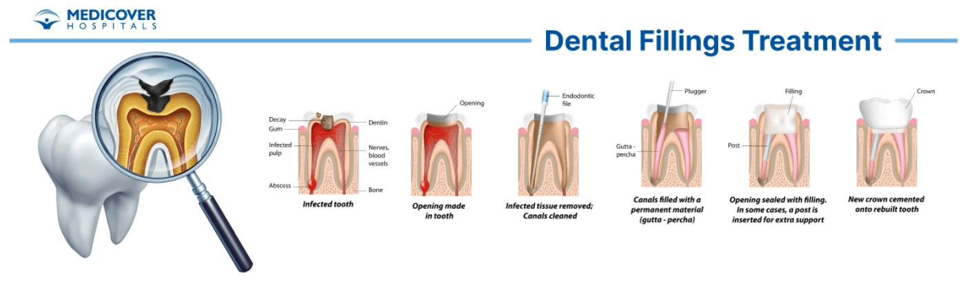 Teeth Filling: Everything You Need To Know in Malaysia
