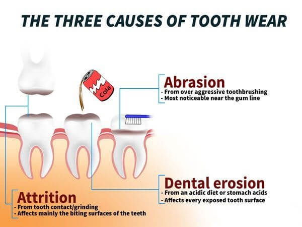 Three Causes of Tooth Wear