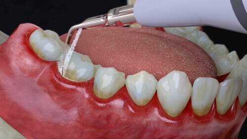 Treatment for gingivitis