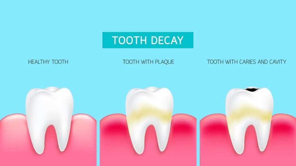 Understanding Tooth Decay