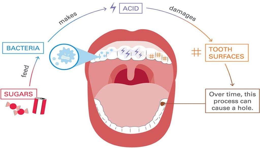 causes of tooth decay