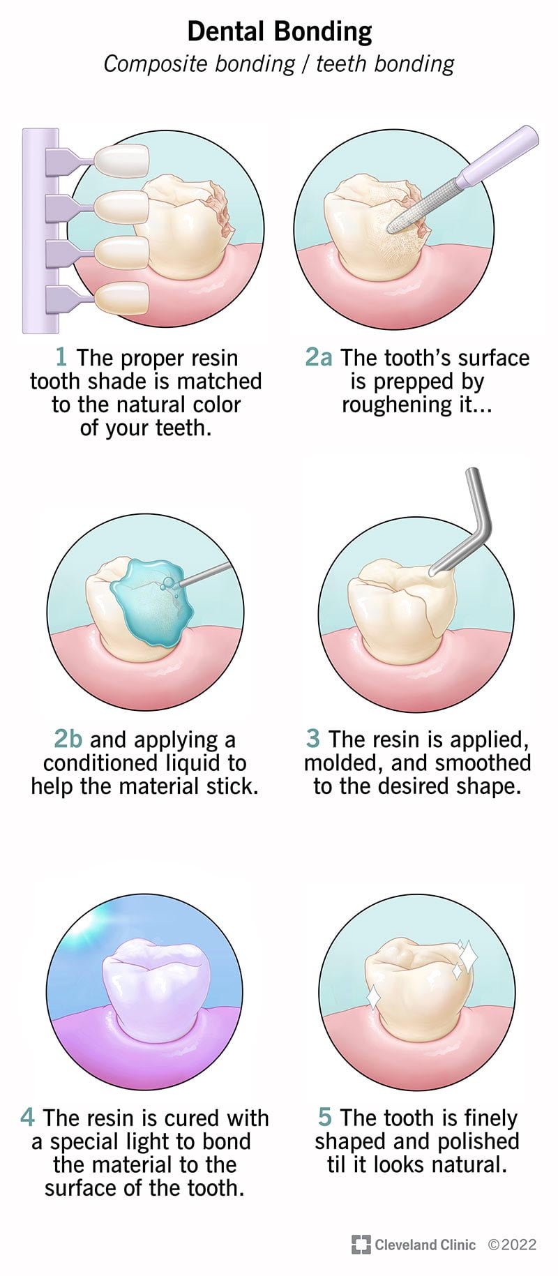 Dental Bonding