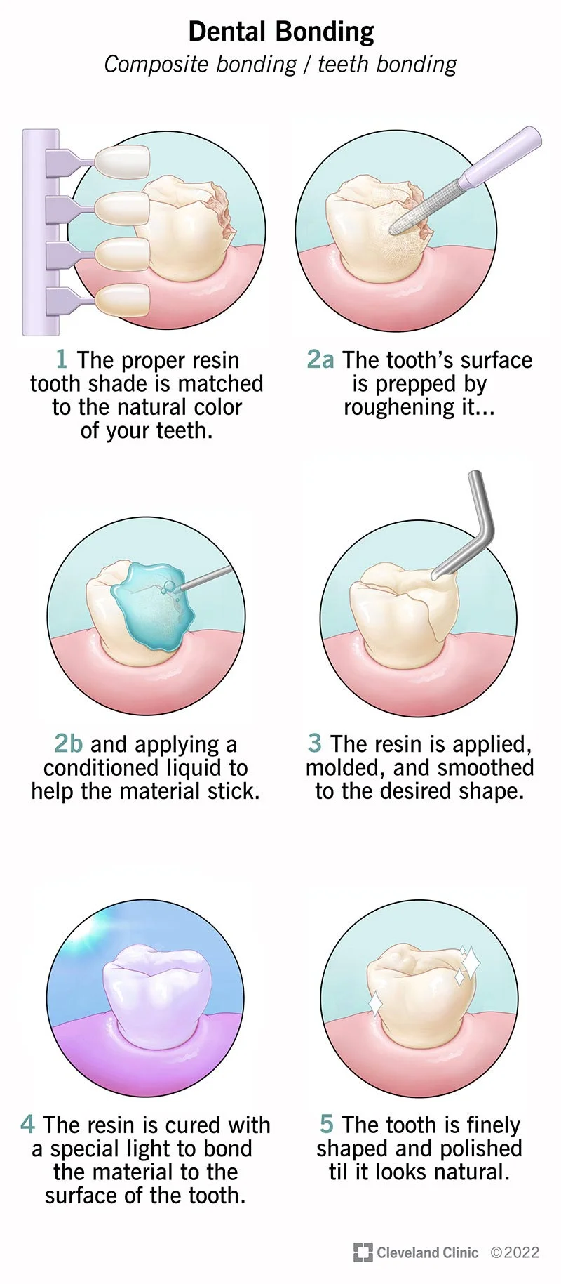 Teeth Bonding: Everything You Need to Know in Malaysia 1 Dental Bonding