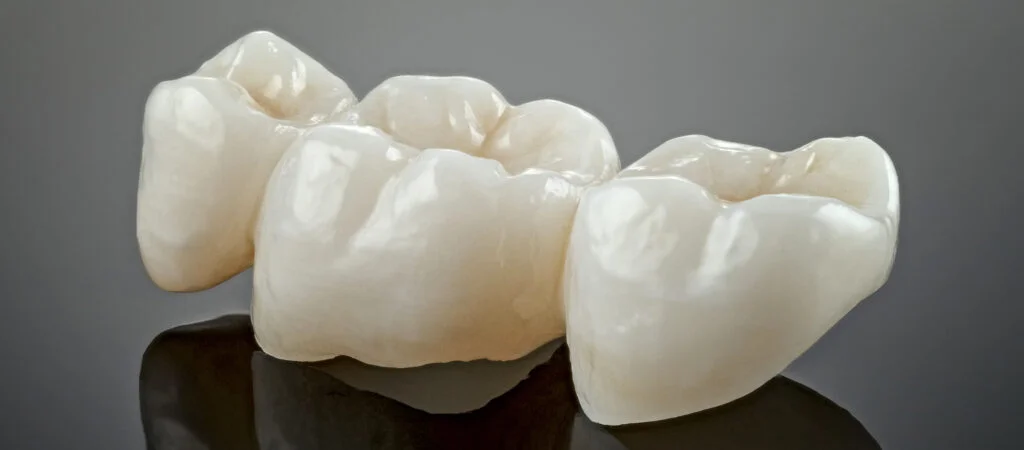 Teeth Bonding: Everything You Need to Know in Malaysia 6 dental crown