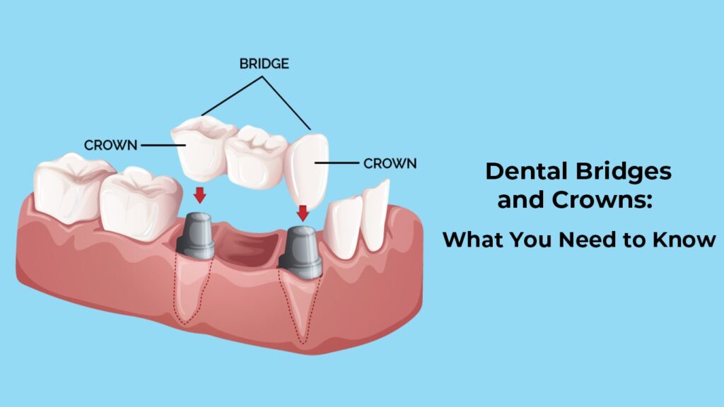 Crown & Bridge: Everything You Need To Know in Malaysia 7 Dental Crowns and Bridges