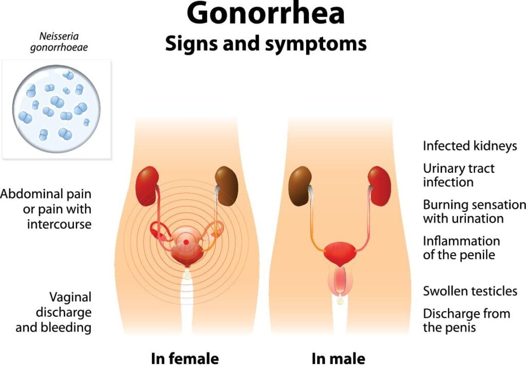 Gonorrhea (clap): Symptoms, Treatment & Prevention in Malaysia 31 gonorrhea diagram