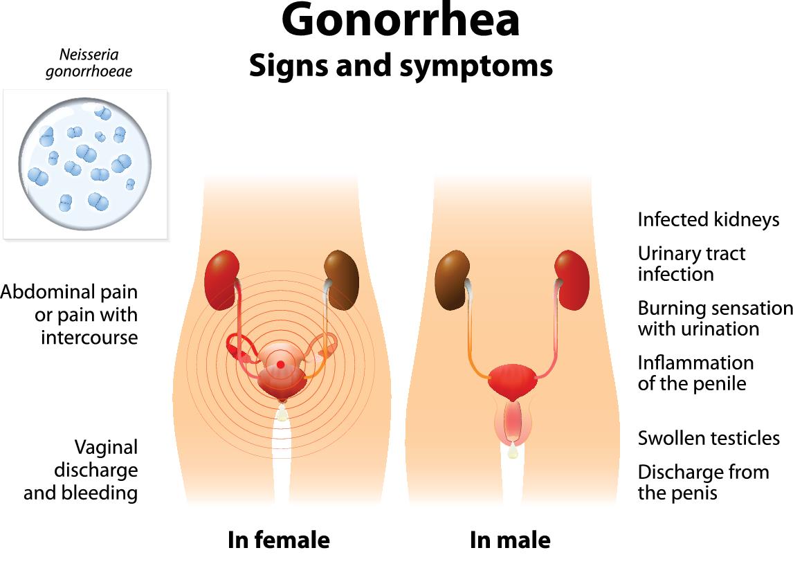 gonorrhea diagram