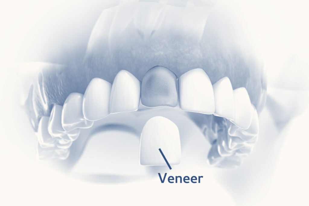Veneers: Everything You Need To Know in Malaysia 19 Veneer