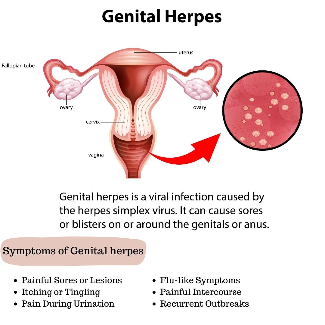 hpv, genital herpes