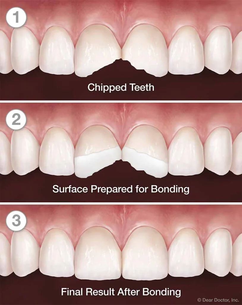 Teeth Bonding: Everything You Need to Know in Malaysia 3 tooth bonding procedure