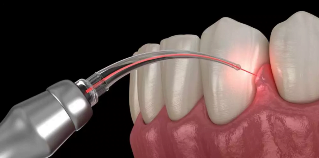 treatment for gum recession