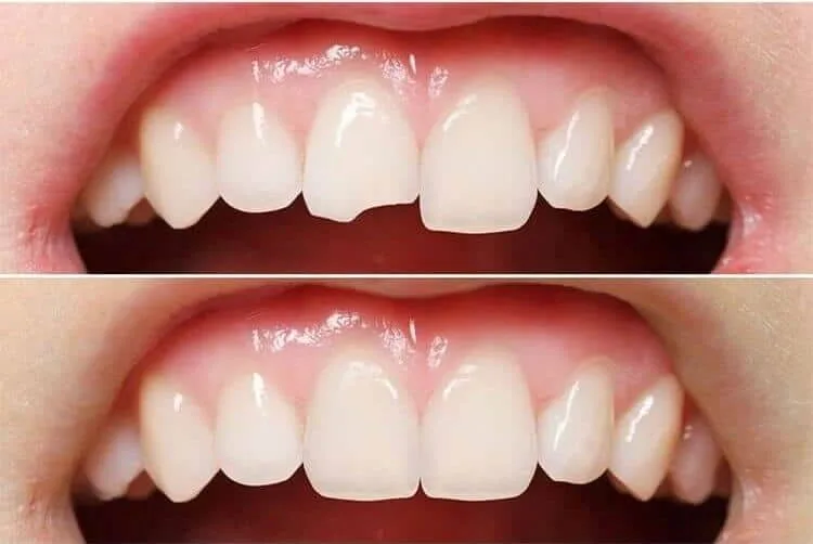 Teeth Bonding: Everything You Need to Know in Malaysia 2 cracks teeth
