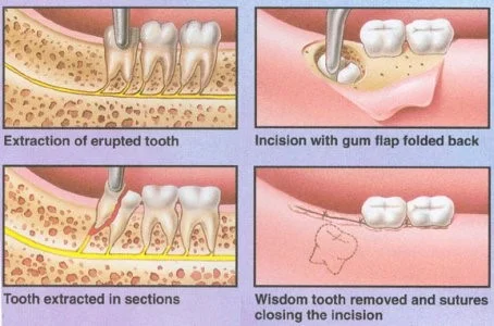 Impacted Wisdom Tooth: Everything You Need to Know in Malaysia 7 wisdom tooth removal process