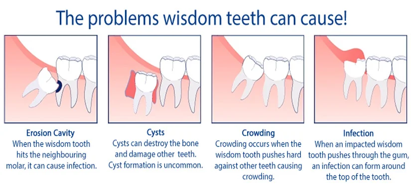Impacted Wisdom Tooth: Everything You Need to Know in Malaysia 4 wisdom6