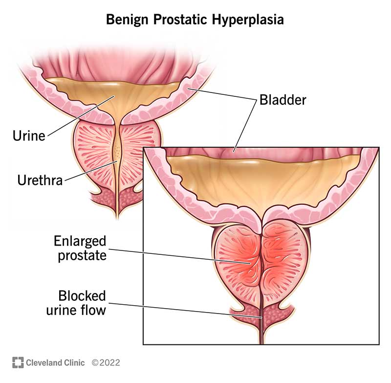 Benign Prostatic Hyperplasia