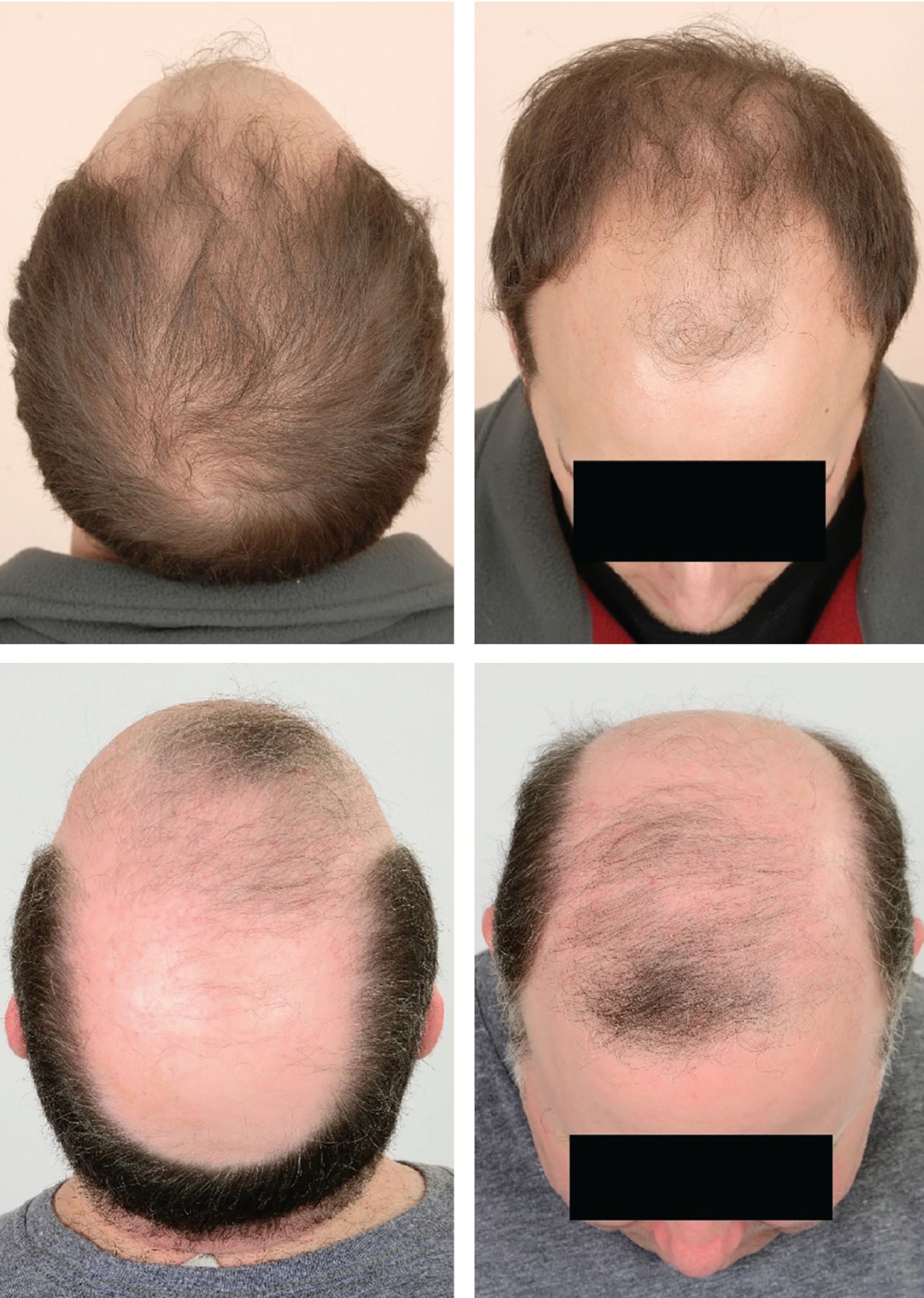 Hair Loss