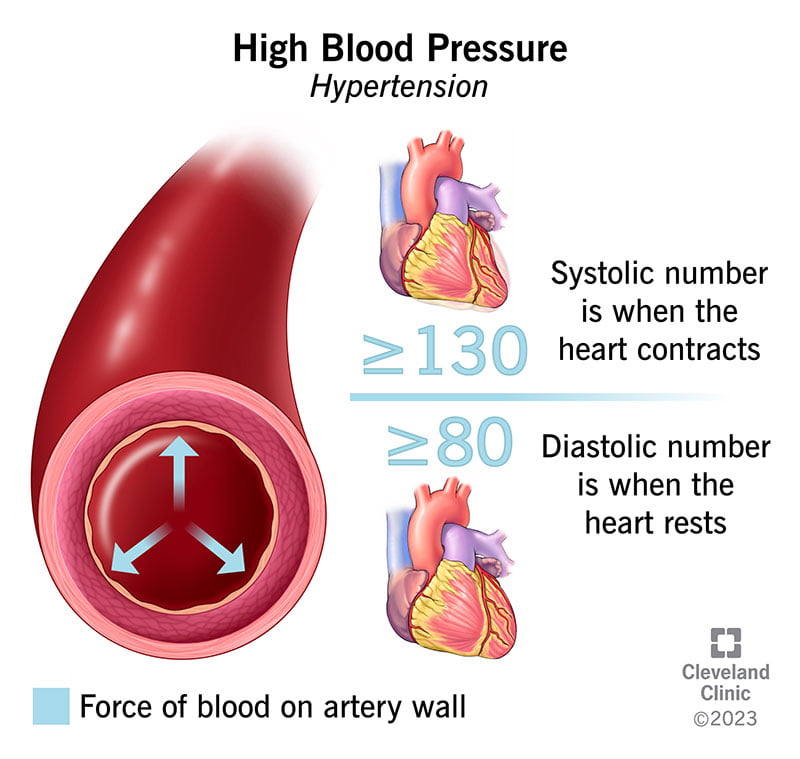 Hypertension