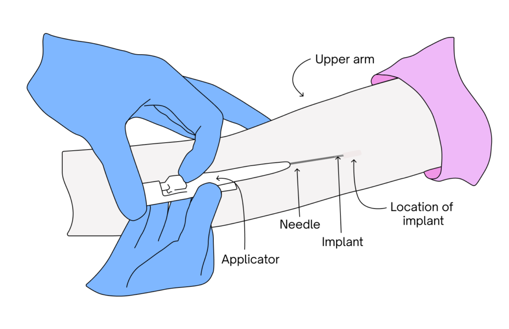 Insertion Process of Implanon