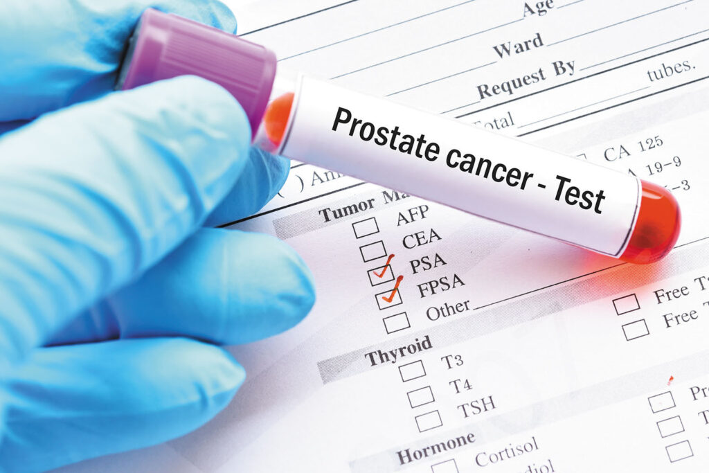 Living With Prostate Cancer