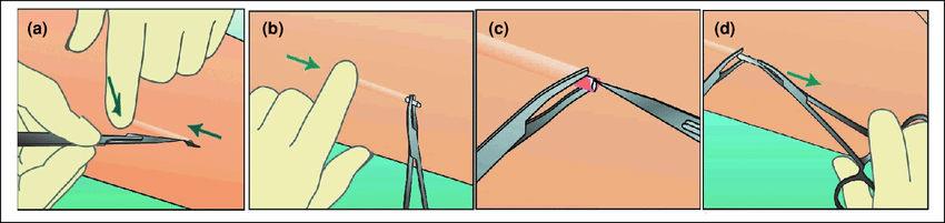 Removal Process of Implanon