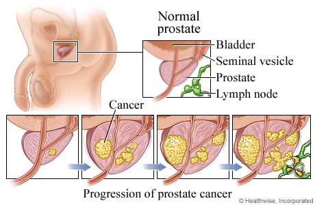 Stages of Prostate Cancer