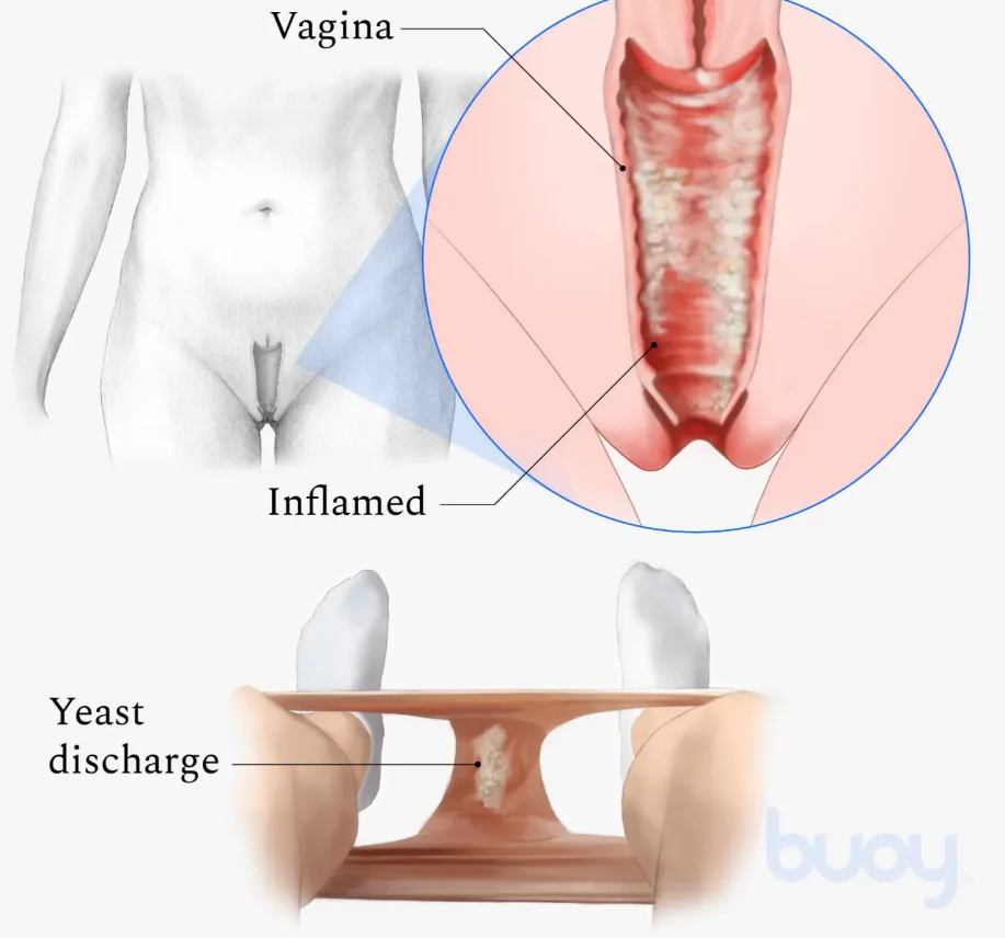 Vaginal Teast Infection Everything You Need to Know in Malaysia