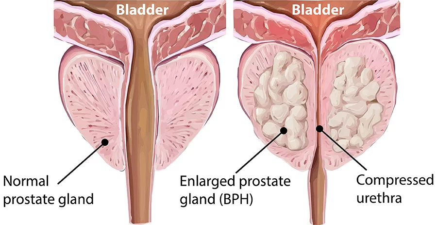 Understanding Benign Prostatic Hyperplasia
