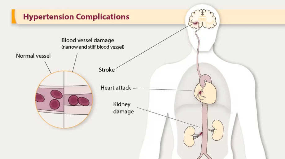 Understanding Hypertension