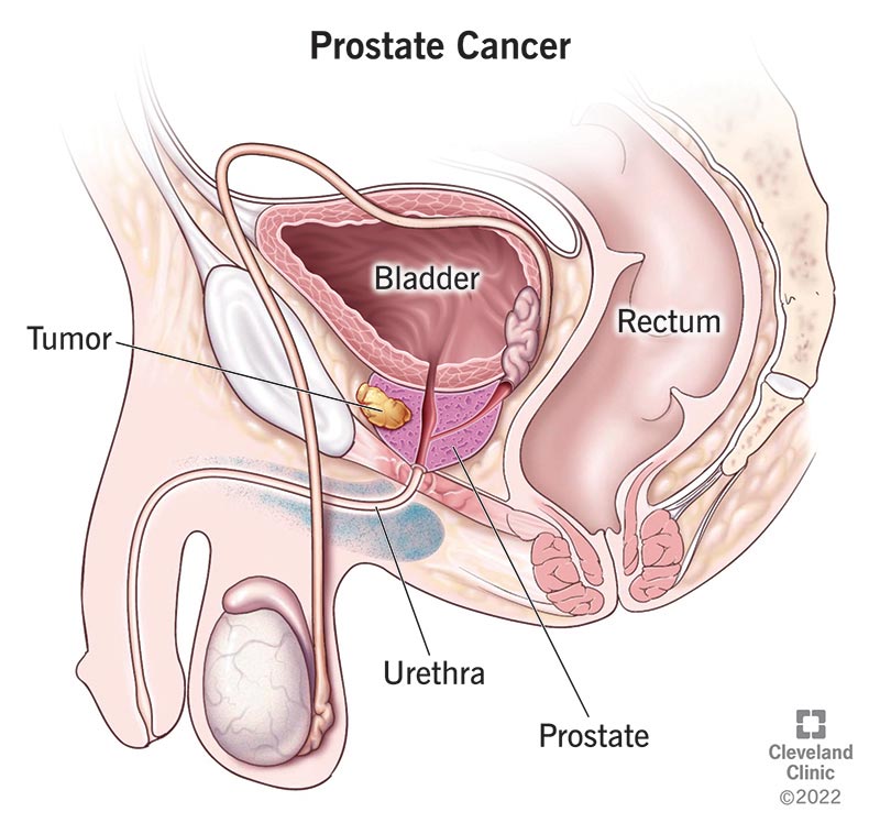 Understanding Prostate Cancer