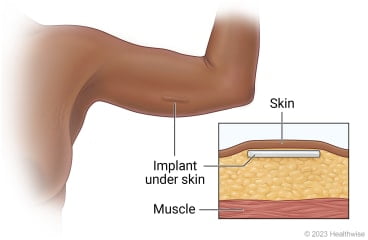 What Is Implanon?