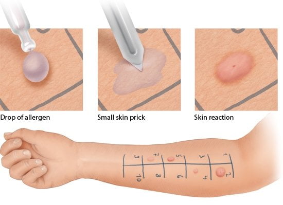 allergy test