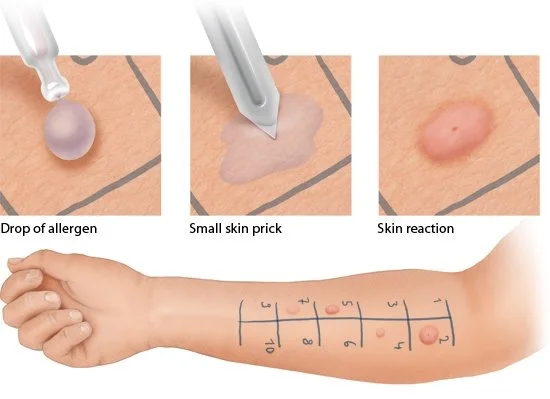 allergy test