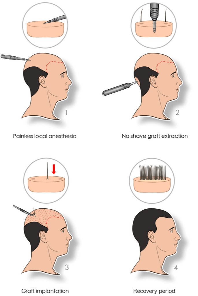 Hair Transplant