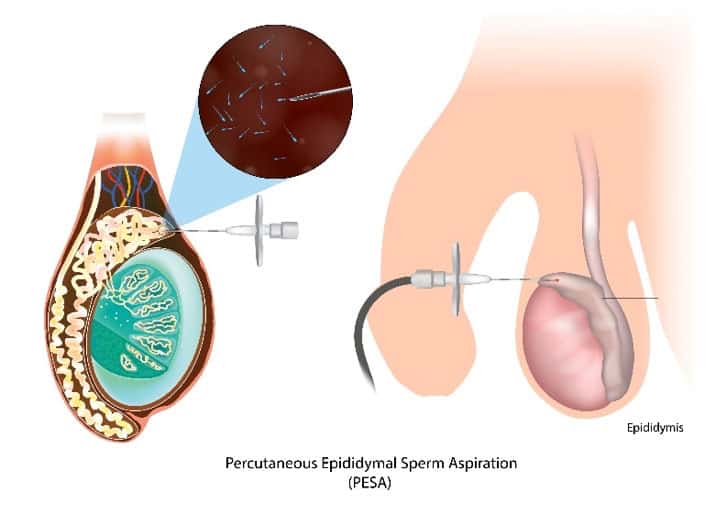 Sperm Retrieval Techniques