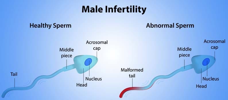 male infertility malaysia